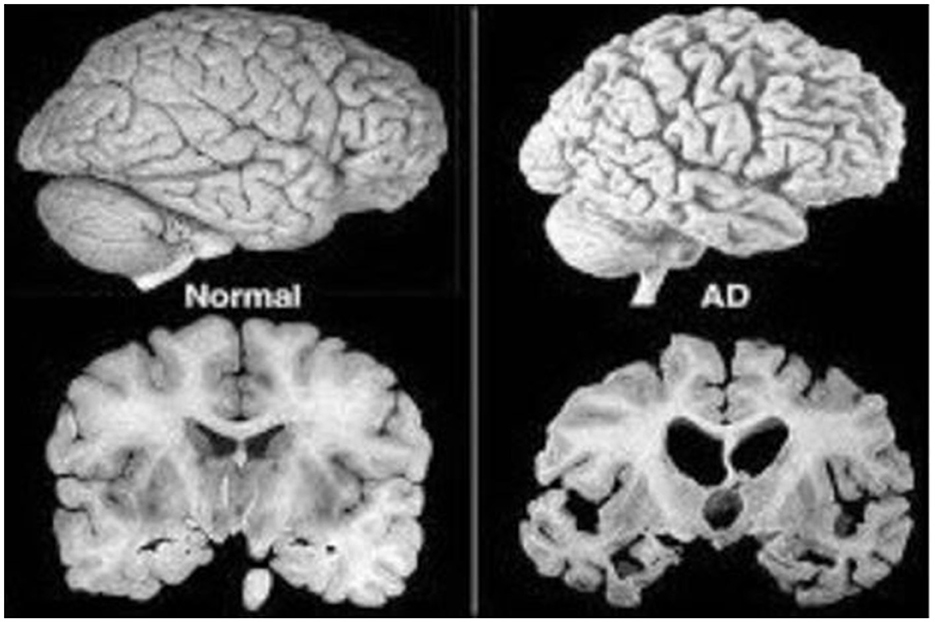 Researchers Discover Neuron Link Possibly Accountable for Disseminating Alzheimer's Disease