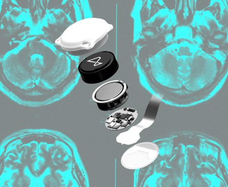 Did Neuralink Gamble Incorrectly?